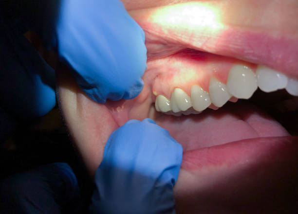 Best Emergency Treatment for Dental Infections or Abscesses in Ester, AK